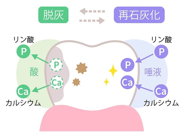 むし歯は何故できるのか？