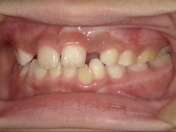 症例8：治療前の側方面②写真