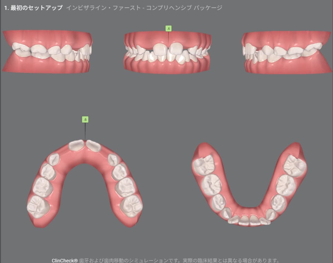 症例8：治療計画シミュレーション・1枚目