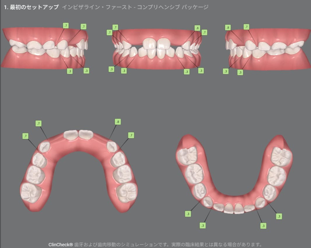 症例8：治療計画シミュレーション・2枚目