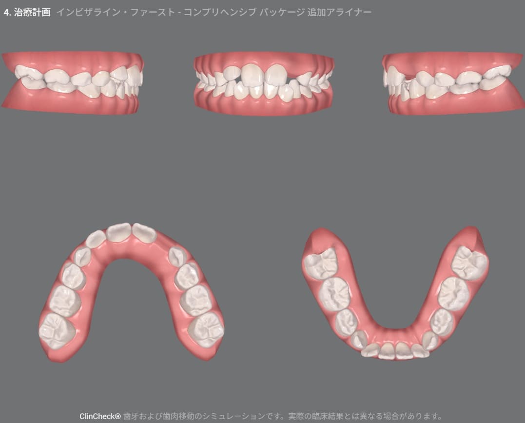 症例8：治療計画シミュレーション・3枚目
