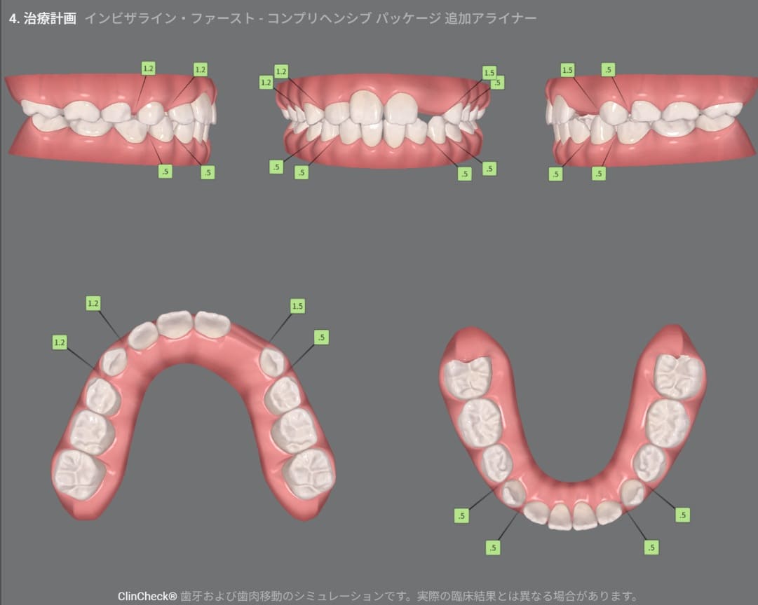 症例8：治療計画シミュレーション・4枚目