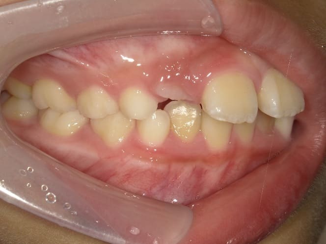 症例9：治療前の側方面①写真