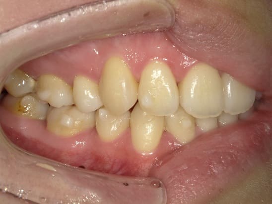 症例10：治療中の側方面①写真