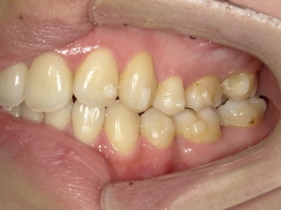 症例10：治療中の側方面②写真