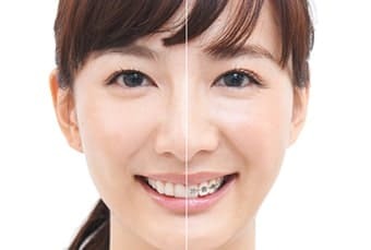 マウスピース矯正とは？